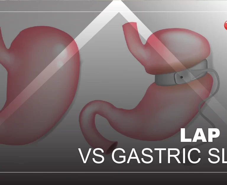 LAP BAND VS GASTRIC SLEEVE