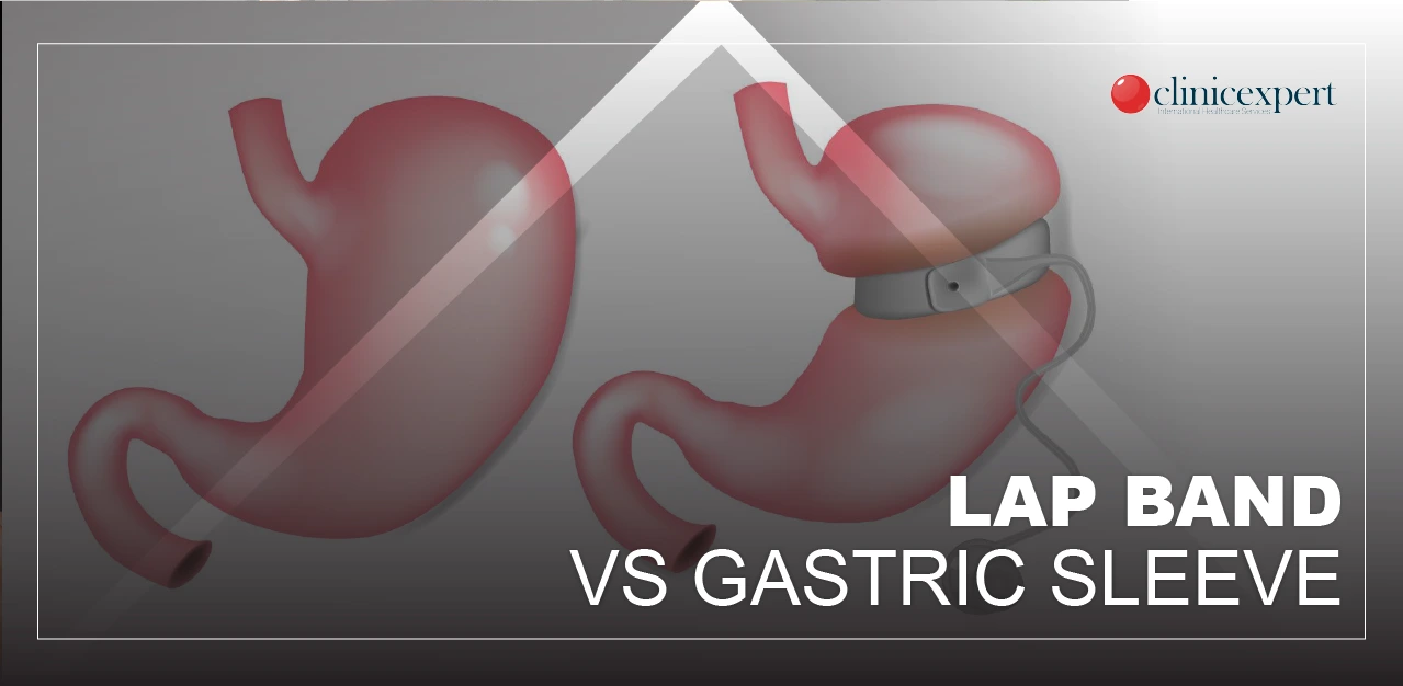 LAP BAND VS GASTRIC SLEEVE