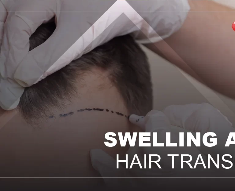 swelling-after-hair-transplant