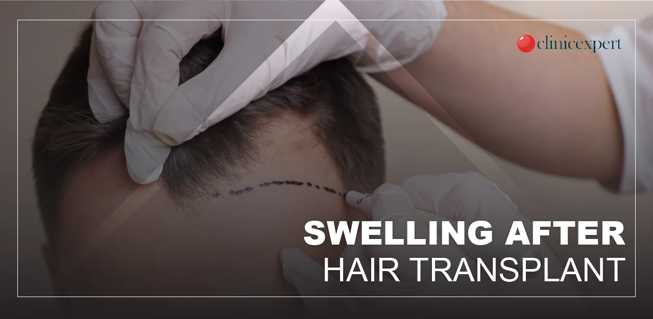 swelling-after-hair-transplant