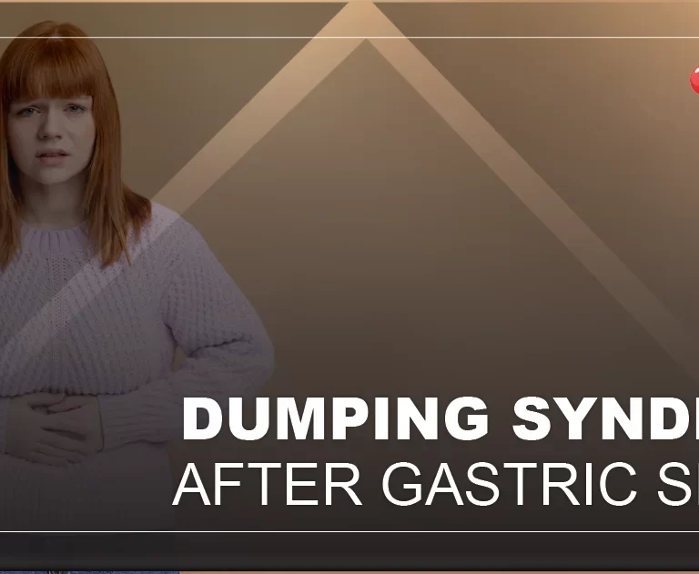 Dumping-syndrome-after-gastric-sleeve