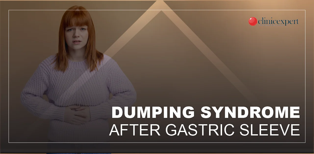 Dumping-syndrome-after-gastric-sleeve