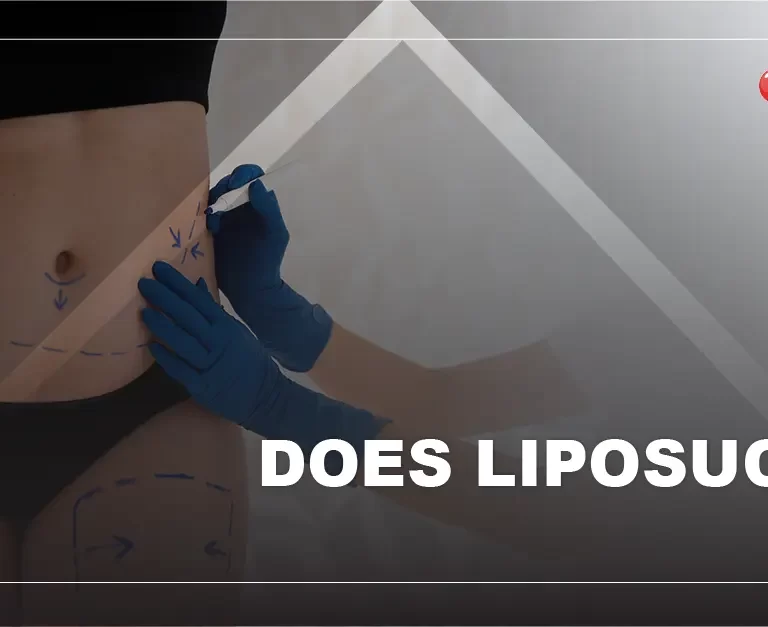 Does Liposuction Work