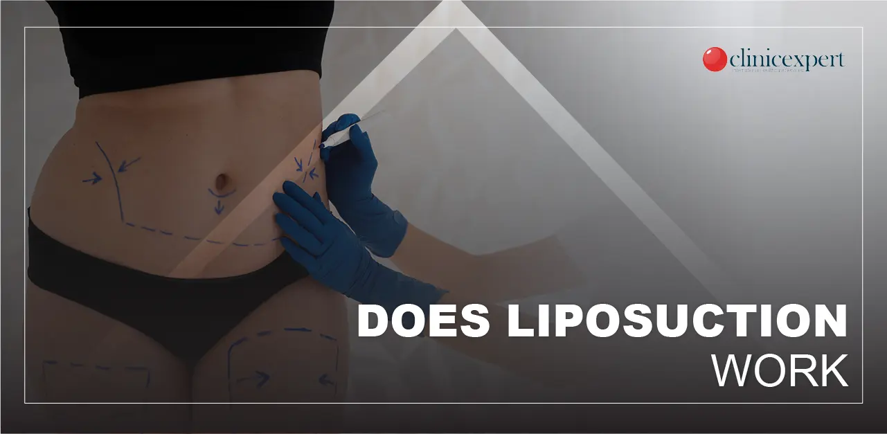 Does Liposuction Work
