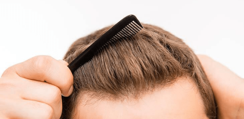 Saç Ekimi Olmadan Saç Çıkarma