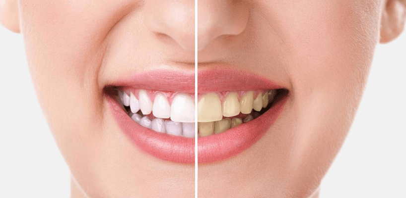 Diş Beyazlatma Nedir?