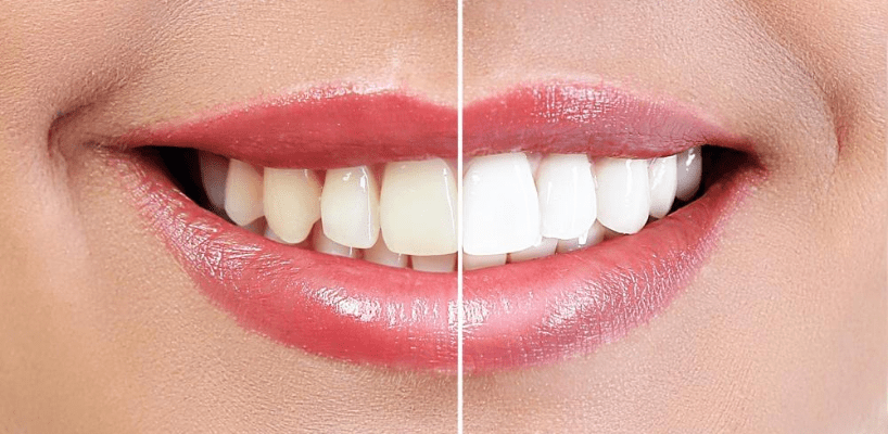 Diş Beyazlatma Ürünleri
