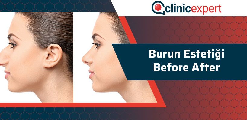 burun-estetigi-before-after-cln