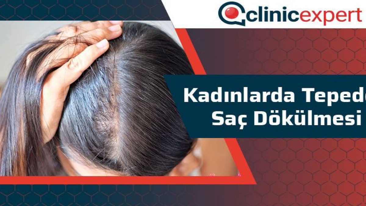 Kadinlarda Tepeden Sac Dokulmesi Clinixexpet Com