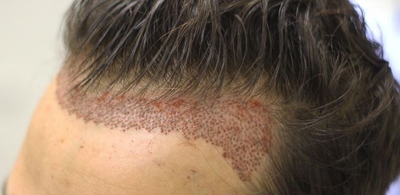 Sac Ekimi 1 Yil Sonrasi Clinicexpert Uluslararasi Saglik Hizmetleri