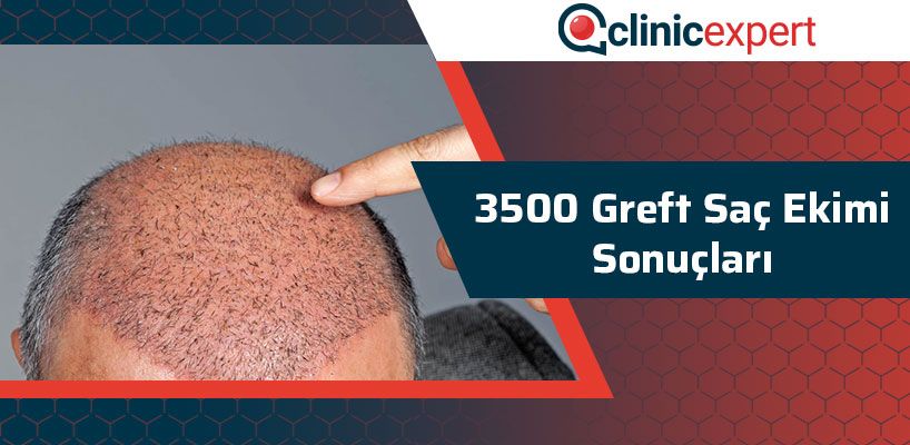 3500 Greft Saç Ekimi Sonuçları