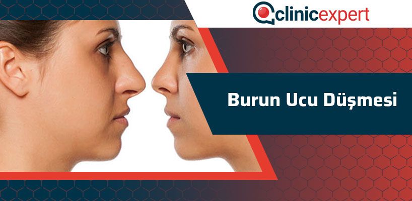 Burun Ucu Düşmesi