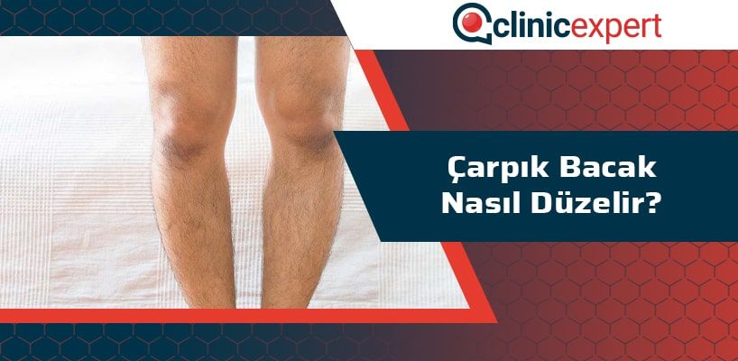 Çarpık Bacak Nasıl Düzelir?