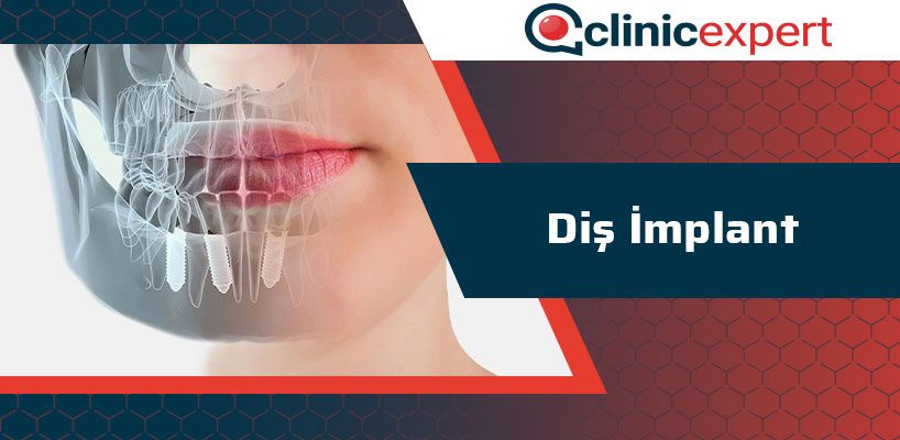 dis-implant-cln