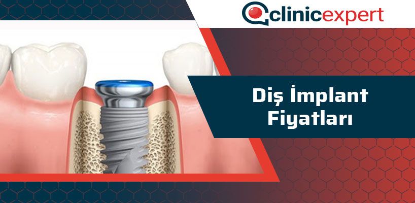 dis-implant-fiyatlari-cln