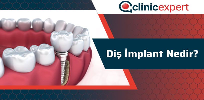 Diş İmplant Nedir? 