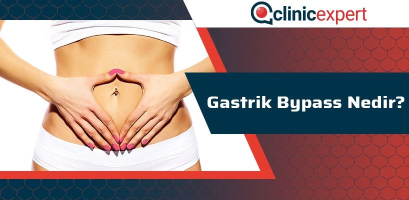 Gastrik Bypass Nedir