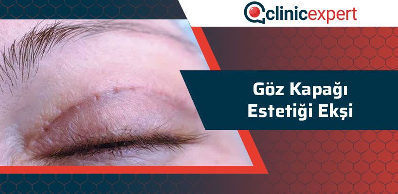 goz-kapagi-estetigi-eksi-cln