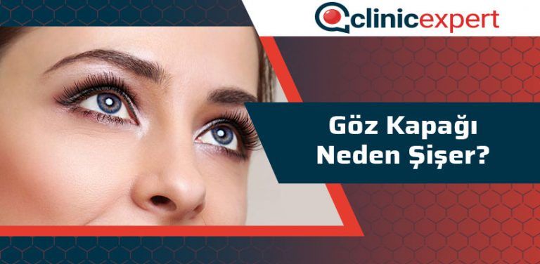 Göz Kapağı Neden Şişer? ClinicExpert Uluslararası Sağlık Hizmetleri