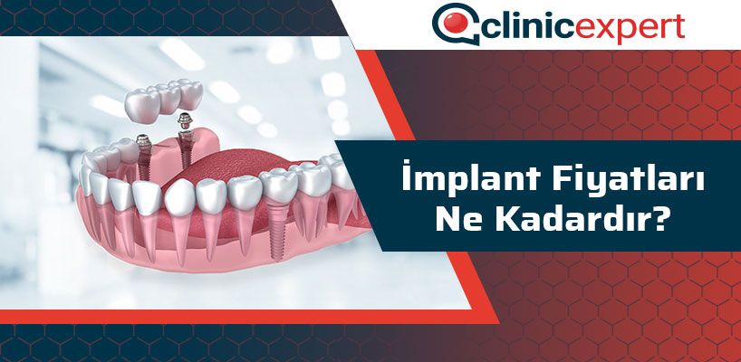 implant-fiyatlari-ne-kadardir-cln