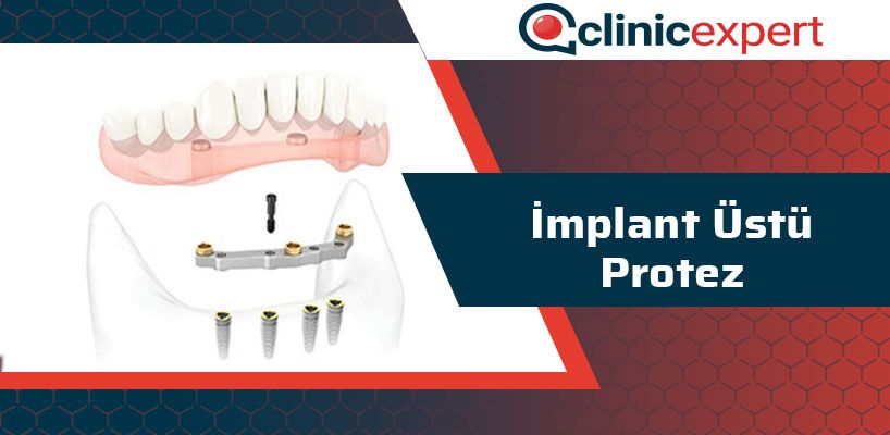 İmplant Üstü Protez