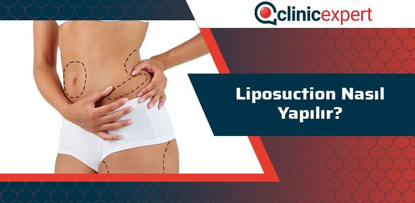 liposuction-nasil-yapilir-cln-min