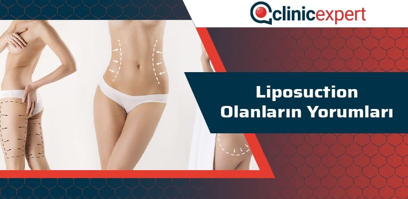 liposuction-olanlarin-yorumlari-cln-min