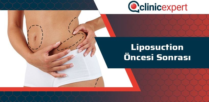 liposuction-oncesi-sonrasi-cln-min