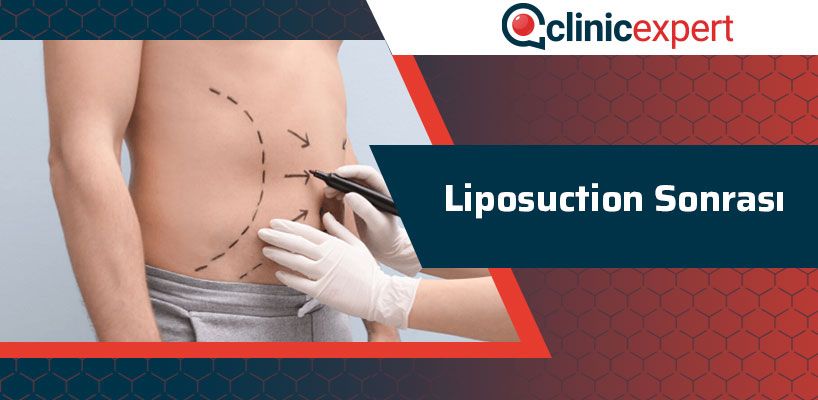 liposuction-sonrasi-cln