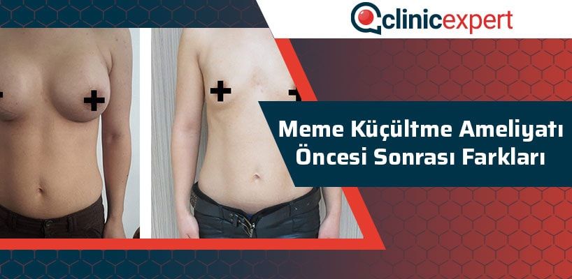 meme-kucultme-ameliyati-oncesi-sonrasi-farklari-cln-min