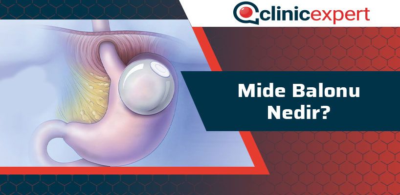 mide-balonu-nedir-cln