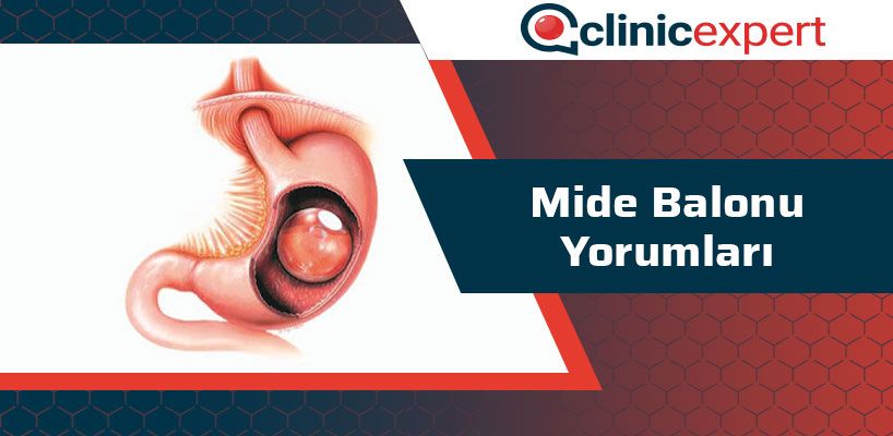 mide-balonu-yorumlari-cln