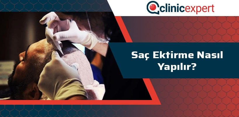 Saç Ektirme Nasıl Yapılır