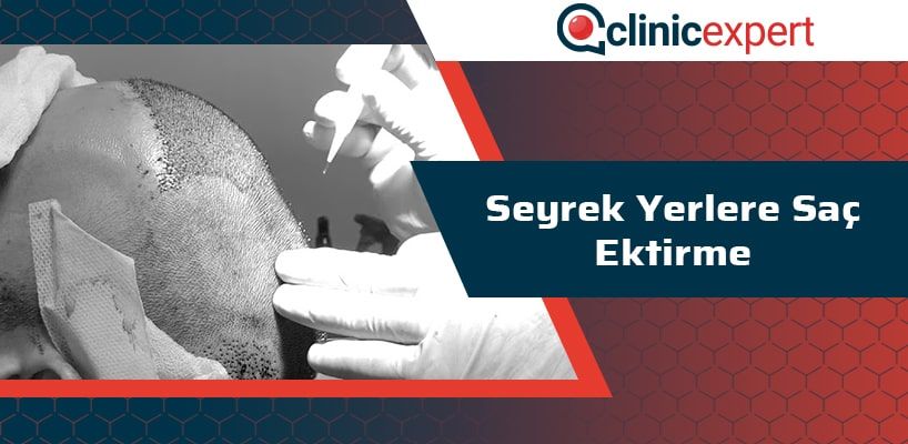 Seyrek Yerlere Saç Ektirme