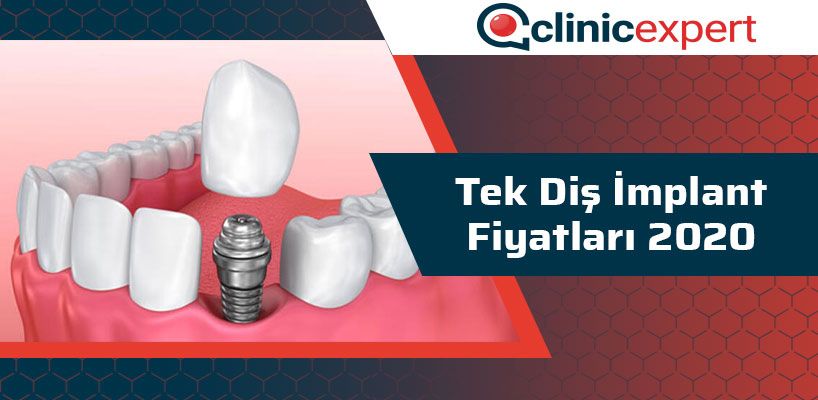 Tek Diş İmplant Fiyatları 2020