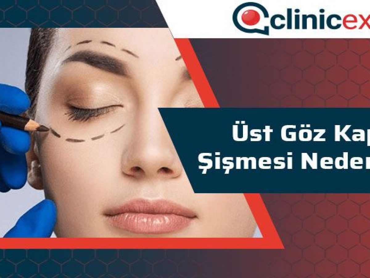 Ust Goz Kapagi Sismesi Neden Olur Clinicexpert Com