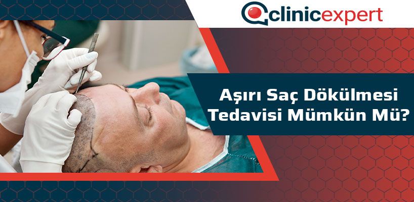 Aşırı Saç Dökülmesi Tedavisi Mümkün Mü?