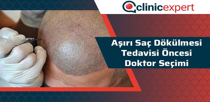 Aşırı Saç Dökülmesi Tedavisi Öncesi Doktor Seçimi