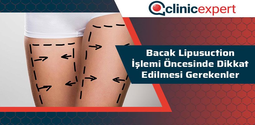 Bacak Liposuction İşlemi Öncesinde Dikkat Edilmesi Gerekenler