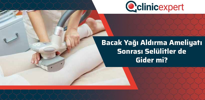 bacak-yagi-aldirma-ameliyati-sonrasi-selulitler-de-gider-mi-cln