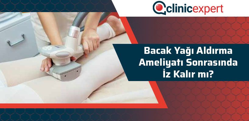 Bacak Yağı Aldırma Ameliyatı Sonrası İz Kalır Mı?