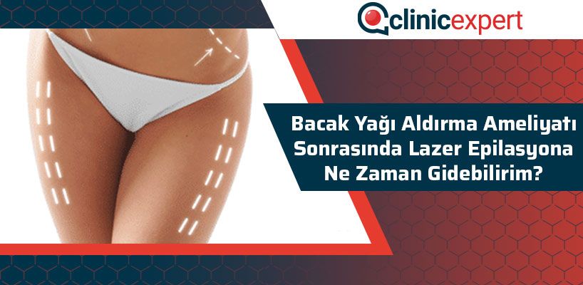 Bacak Yağı Aldırma Ameliyatı Sonrasında Lazer Epilasyona Ne Zaman Gidebilirim? 