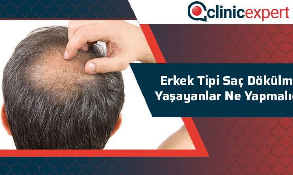 Erkek Tipi Sac Dokulmesi Yasayanlar Ne Yapmalidir Clinicexpert