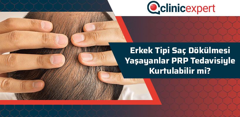 Erkek Tipi Saç Dökülmesi Yaşayanlar PRP Tedavisiyle Kurtulabilir Mi?