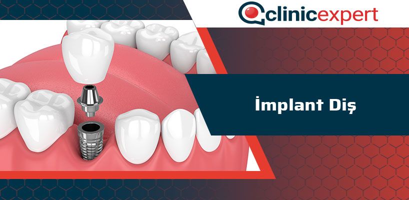 implant-dis-cln