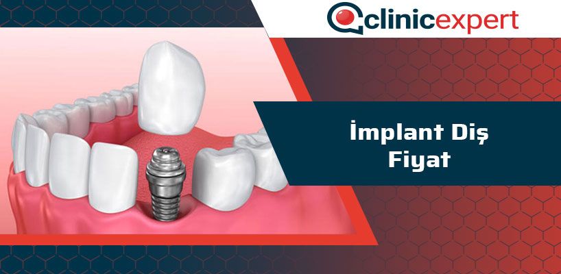 implant-dis-fiyat-cln