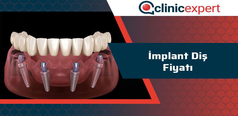 implant-dis-fiyati-cln