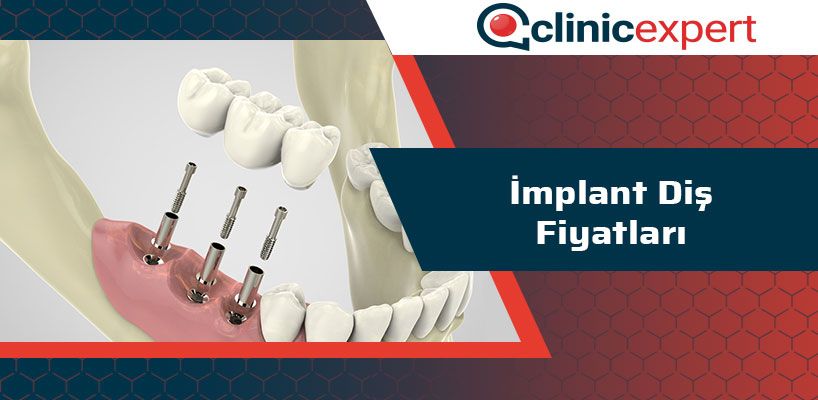 implant-dis-fiyatlari-cln