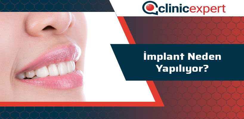 implant-neden-yapiliyor-cln