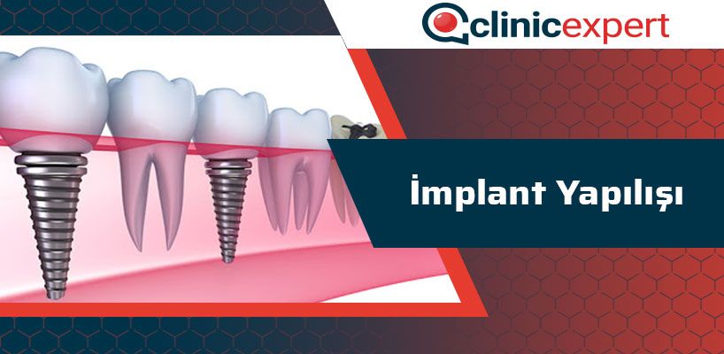 implant-yapilisi-cln